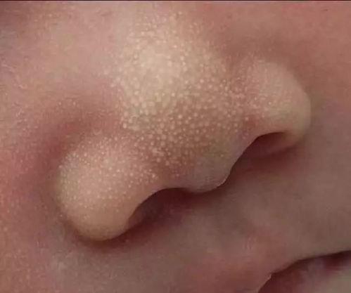 吃小白瓜嘴角起泡